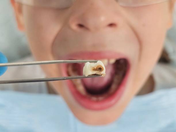 Best Emergency Tooth Extraction in Alum Rock, CA